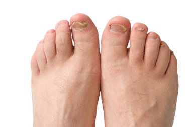 Fungus of toenails and human skin. Close-up. Isolate clipart
