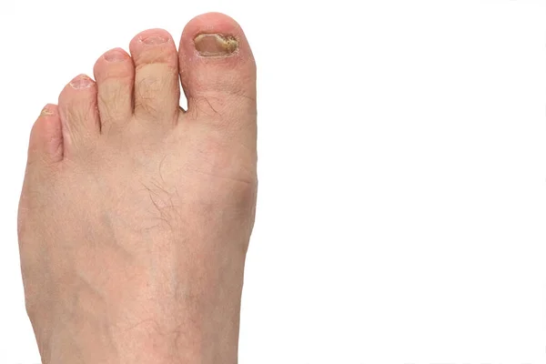 Houba Nehtů Nohou Lidská Kůže Detailní Záběr Izolovat — Stock fotografie