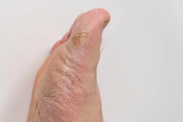 Fungus Foot Person Close Isolate — Stock Photo, Image
