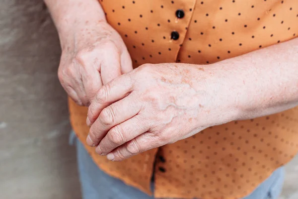 Mãos de mulher mais velha. Reumatismo, artrite, dor nas articulações — Fotografia de Stock