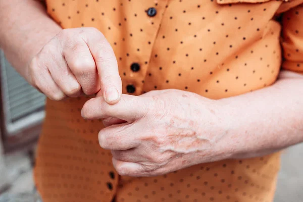 나이많은 여자 손. 류머티즘, 관절염, 관절통 — 스톡 사진