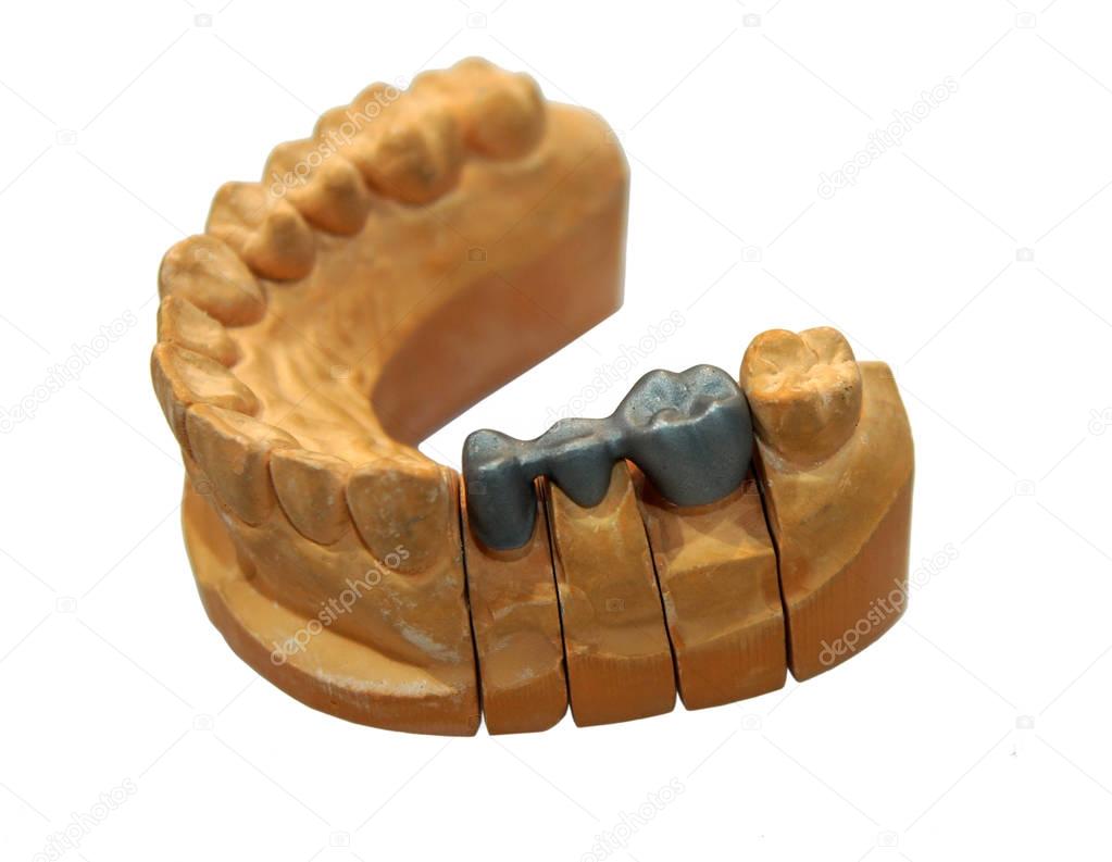 Dental bridge and crowns 