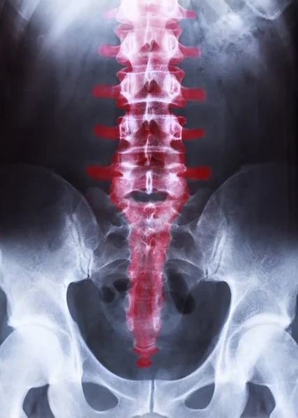 Radiografia da pelve e coluna vertebral — Fotografia de Stock