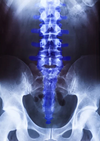 Radiografia da pelve e coluna vertebral — Fotografia de Stock