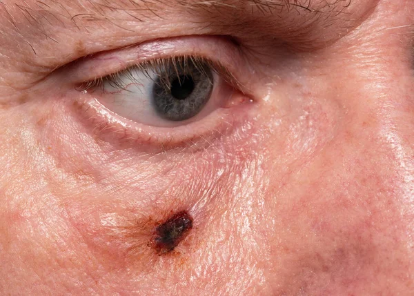 Wound Causian Male Cheek Removal Suspected Skin Cancer Spot — Stock Photo, Image