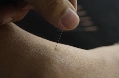 Akupunktur iğne kullanarak ele detayını makro
