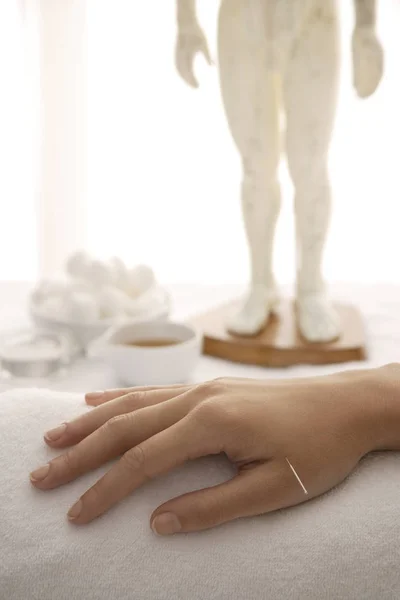 Agulha de acupuntura na mão da mulher — Fotografia de Stock