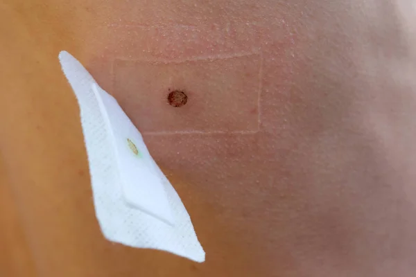 Foco Seletivo Cicatriz Imediatamente Após Remoção Laser Toupeira Uma Ferida — Fotografia de Stock