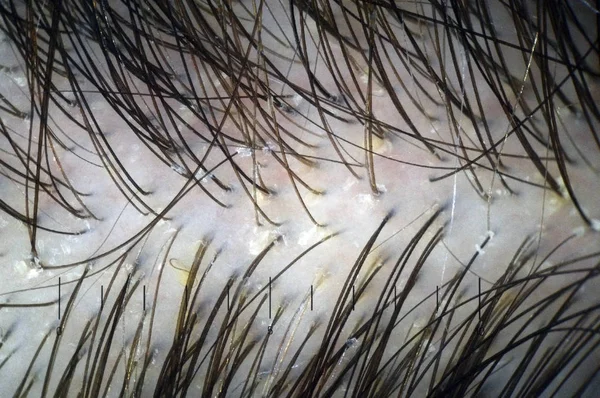 Скальп Волосся Численними Відшаруваннями Макроскопія Волосся Голові Ознаками Пілінгу Волосяних — стокове фото
