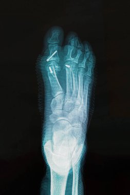 Hallux varus durumunu düzeltmek için ameliyattan sonra ayak röntgeni..
