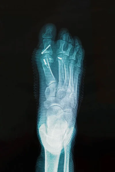 X-ray of foot after surgery to correct Hallux varus condition. — ストック写真