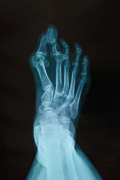 X-ray of the right foot. — ストック写真