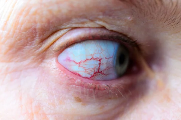 Eye Red Blood Vessels Macro — Stock Photo, Image