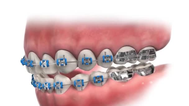 Instalación Abrazaderas Metal Close Animación Médica — Vídeos de Stock