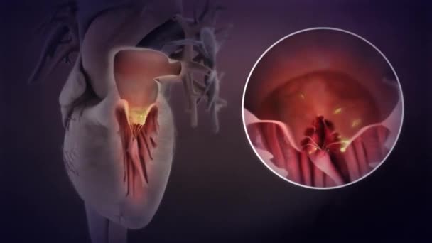 Medische Animatie Van Endocarditis Een Kloppend Hart — Stockvideo