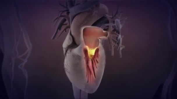 Animacja Medyczna Zapalenia Wsierdzia Rozprzestrzenianie Się Drobnoustrojów Krwiobiegu Przyczepność Uszkodzonych — Wideo stockowe
