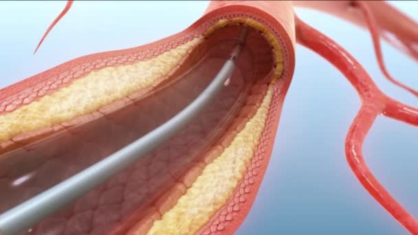 Boyutlu Tıbbi Animasyonun Vasküler Erişimine Gastent Ekle — Stok video