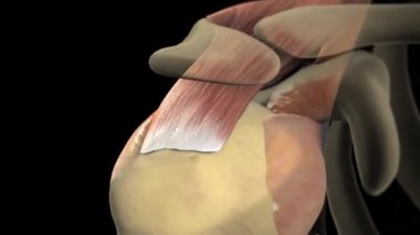 Döndürme manşet yırtığı, omuz manşetindeki bir ya da daha fazla tendon ya da kasın yaralanmasıdır.