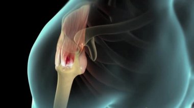 Döndürme manşet yırtığı, omuz manşetindeki bir ya da daha fazla tendon ya da kasın yaralanmasıdır.