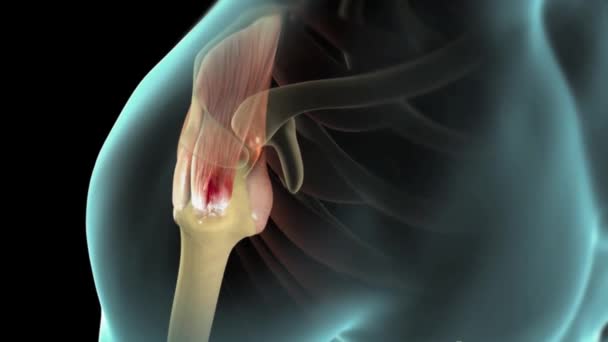 Rotator Cuff Tear Injury One More Tendons Muscles Rotator Cuff — Stock Video