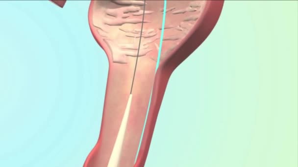 支架插入的三维医学动画 — 图库视频影像