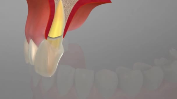 牙齿断裂是指牙齿坚硬的外壳破裂或开裂 — 图库视频影像