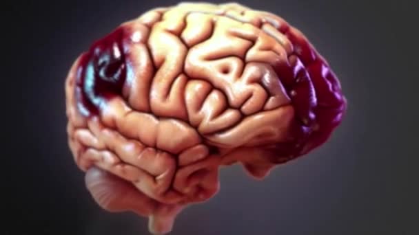 Травматическая Травма Головного Мозга Известная Внутричерепная Травма Происходит Внешняя Сила — стоковое видео
