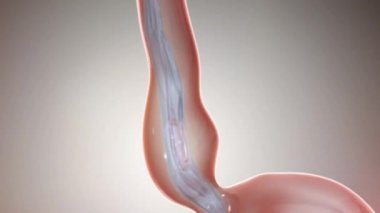 Yemek borusu iltihabının yaygın sebepleri arasında mide içinde asit bulunduran kasların zayıflığı nedeniyle GERD ve asit reflüsü bulunur..