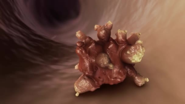 Ureter Giunzione Pelvica Animazione — Video Stock