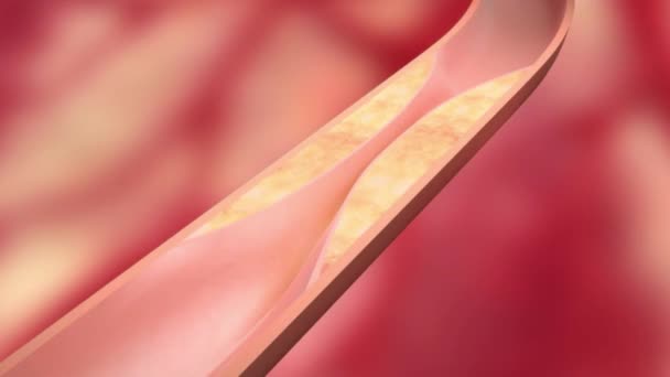 Vascular Occlusion Healing Medical Animation — Stock Video