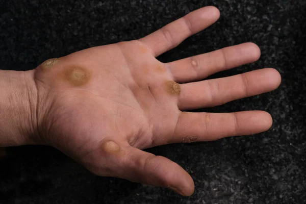 Problema dermatológico, verrugas verruca, en la mano del trabajador, concepto de atención médica —  Fotos de Stock