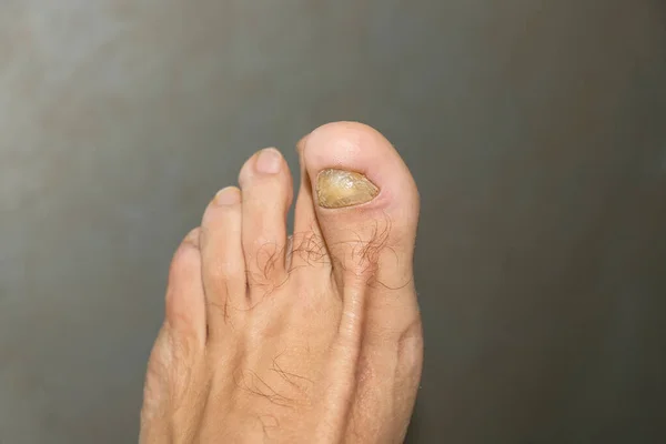 Giovane ragazzo dita a piedi nudi con unghie onycho micosi malati, problemi dermatologici — Foto Stock