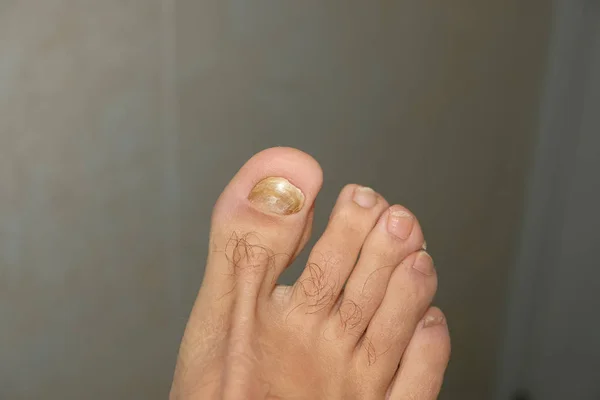 Young guy barefoot fingers with sick onycho mycosis nails,dermatologic medical — 스톡 사진