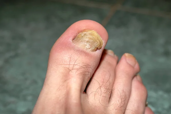 Dedos humanos com unhas onicho micose doente, cuidados de saúde dermatológicos, médicos — Fotografia de Stock