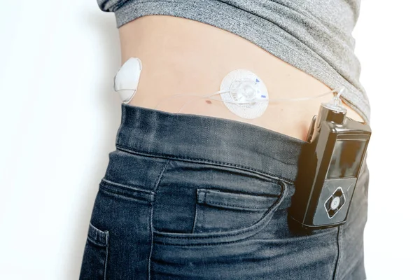 Close Female Diabetic Patient Infusion Insulin Pump Connected Belly Medical — Stock Photo, Image