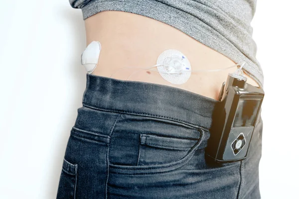 Närbild Kvinnlig Diabetespatient Med Infusionspump Ansluten Magen Medicinteknisk Produkt Med — Stockfoto