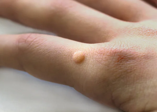Common wart ( Verruca vulgaris ) a flat wart commonly found on t — Stock Image Common wart ( Verruca vulgaris ) a flat wart commonly found on t Stock Picture