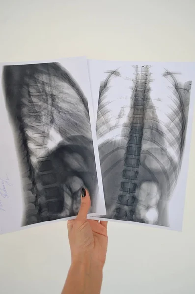 Rengen spine picture - diagnosis examination — Stock Image Rengen spine picture - diagnosis examination Stock Image