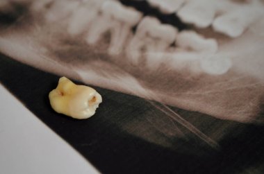 Panoramik resim supercomplete diş. x-ışını