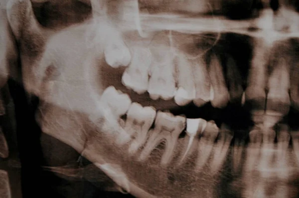 Panoramic picture of supercomplete teeth. x-ray — Stock Photo, Image