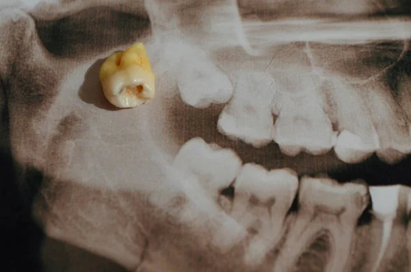 Imagen panorámica de dientes supercompletos. Rayos X — Foto de Stock