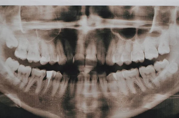 Imagem panorâmica de dentes supercompletos. Raio-X — Fotografia de Stock