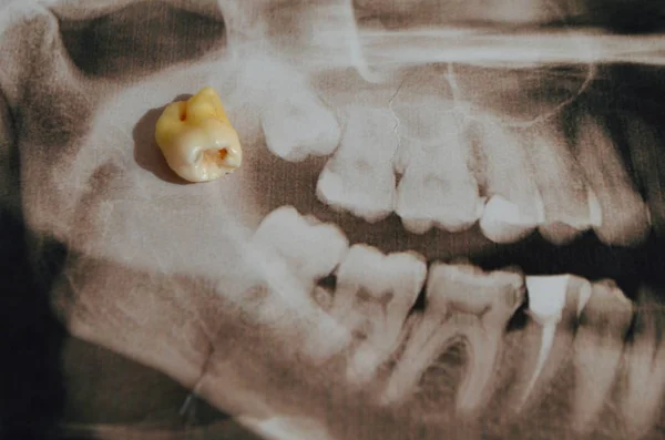 Imagem panorâmica de dentes supercompletos. Raio-X — Fotografia de Stock