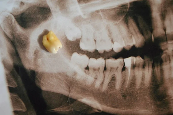 Panoramik resim supercomplete diş. x-ışını — Stok fotoğraf