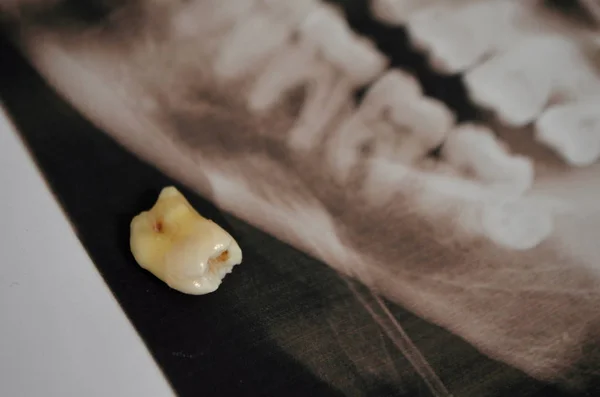 Supercomplete 牙齿的全景图片。x 射线 — 图库照片