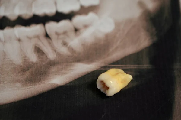 Imagen panorámica de dientes supercompletos. Rayos X — Foto de Stock