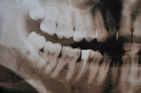Panoramic picture of supercomplete teeth. x-ray — Stock Photo, Image
