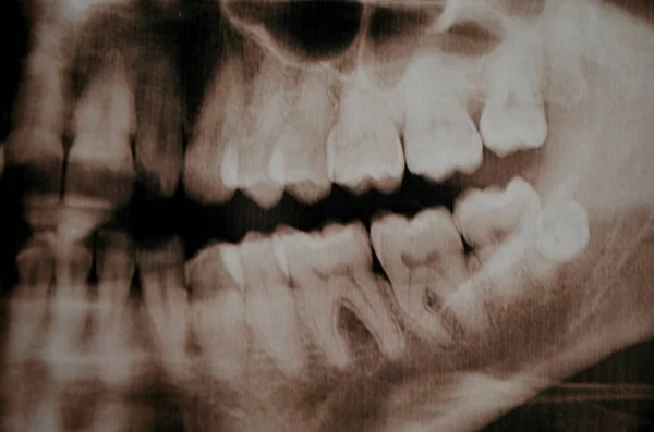 Панорамная картина суперполных зубов. X-ray — стоковое фото