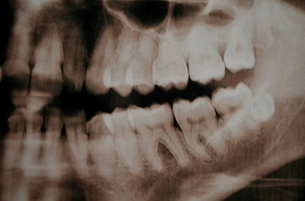 Panoramiczne zdjęcie zębów supercomplete. x-ray — Zdjęcie stockowe