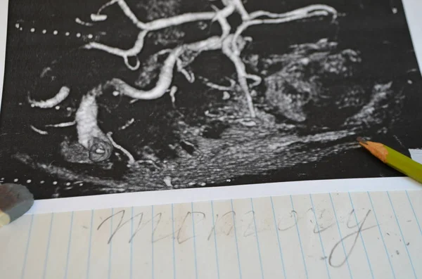 Изучение Мозга После Инсульта Нейронный Макрос — стоковое фото